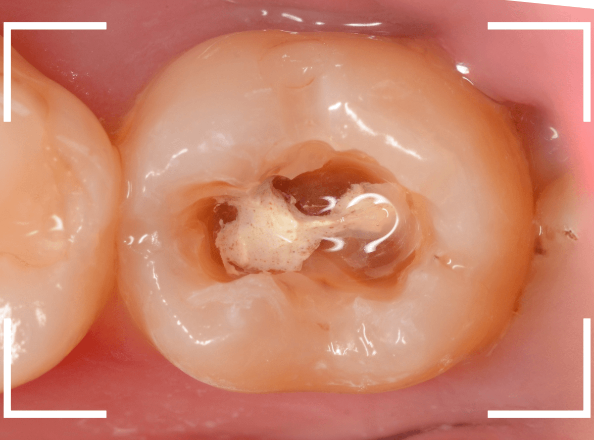 レントゲンでわかりづらい虫歯17-3