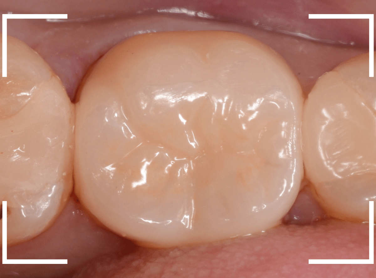 セラミック治療(クラウン・奥歯)7-6