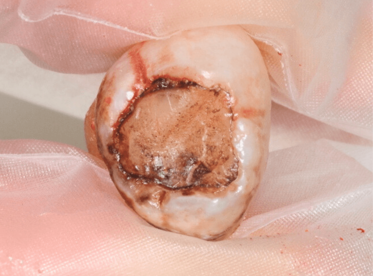 おやしらずの抜歯4-2