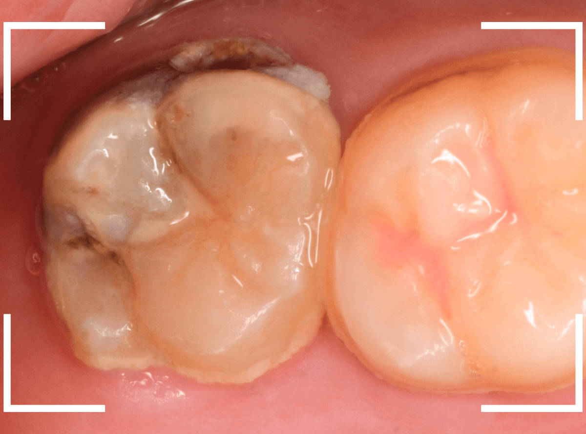 気づかないうちに深い虫歯6-1