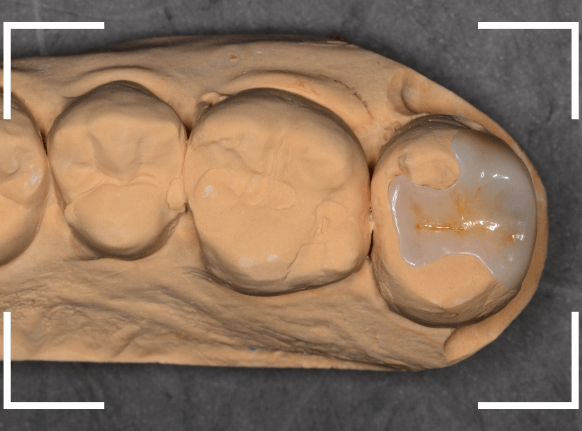 気づかないうちに深い虫歯5-6