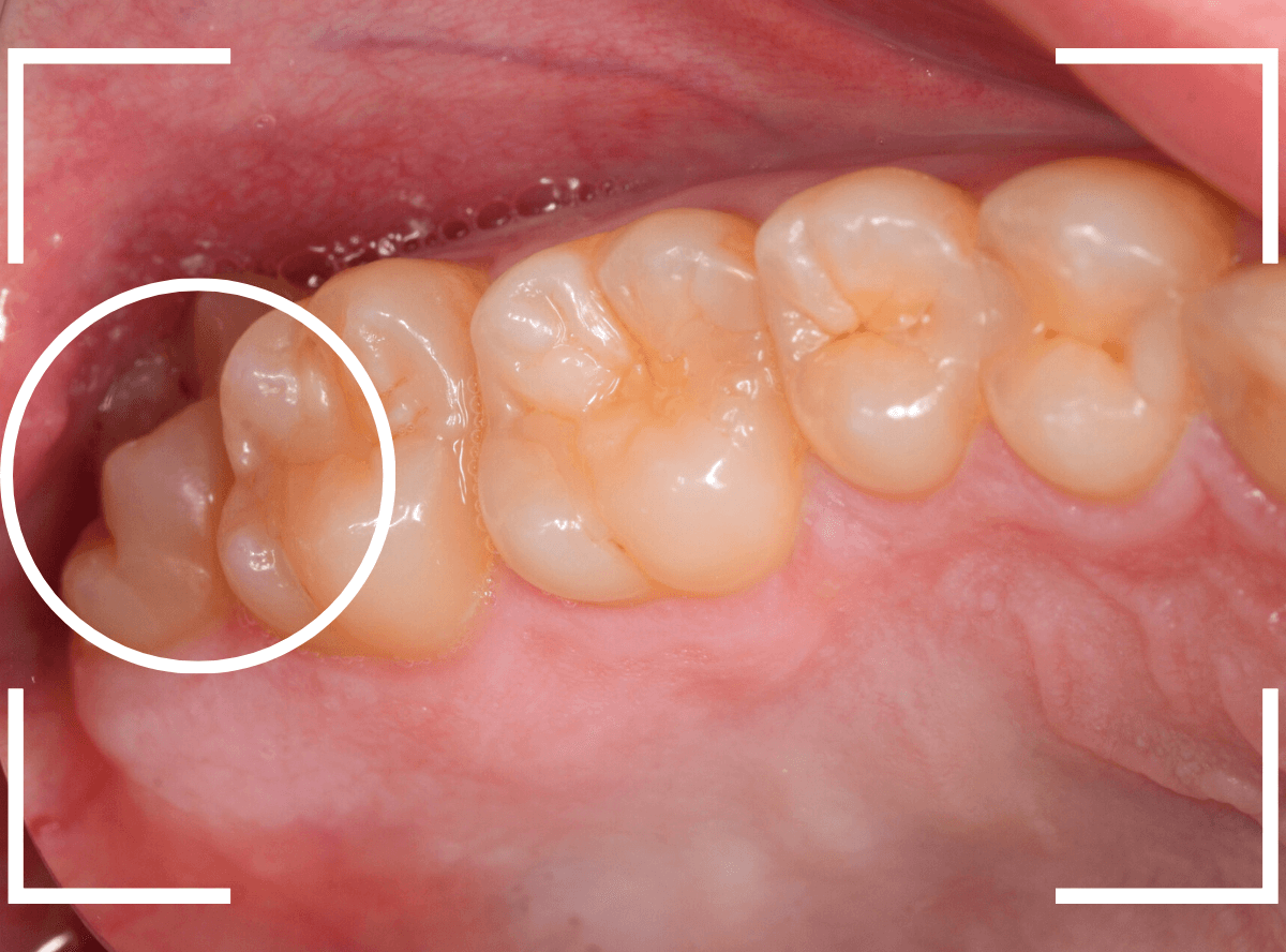 おやしらずの抜歯9-1
