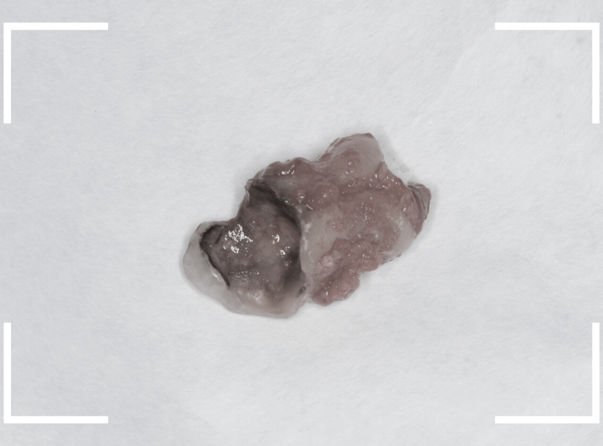 おやしらずの抜歯17-3