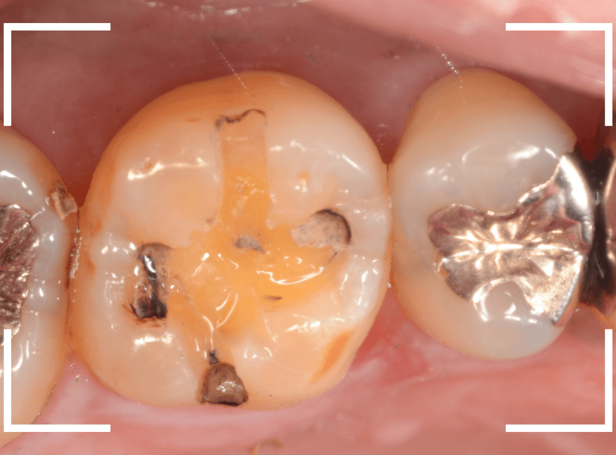 歯と歯の間の虫歯25-3