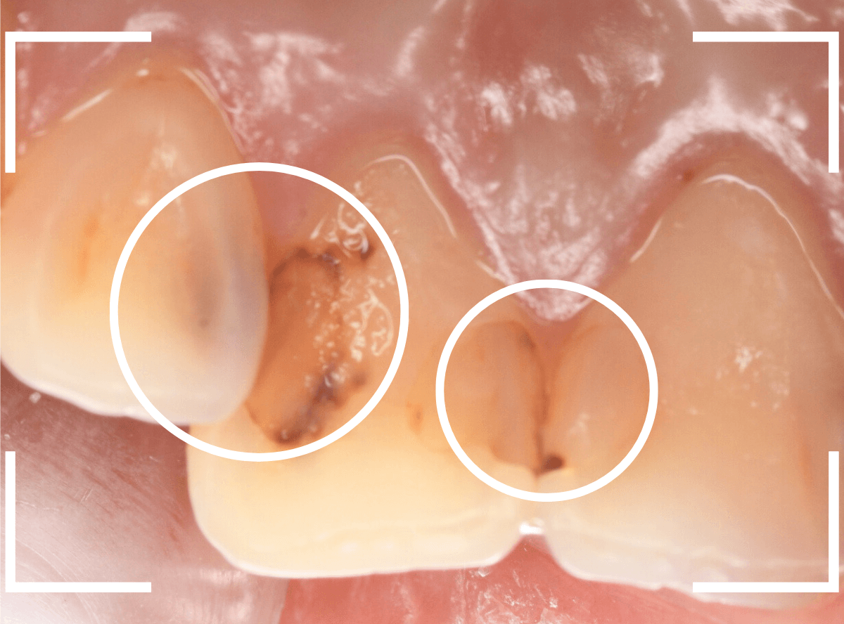 コンポジットレジン治療6-1
