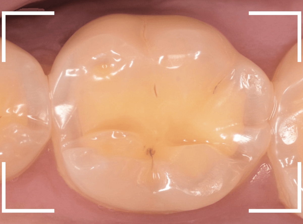 知覚過敏の画像4-1