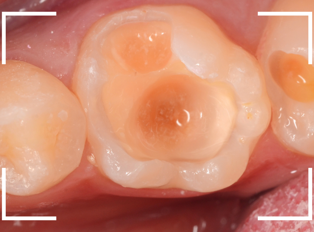 小窩裂溝う蝕5-6