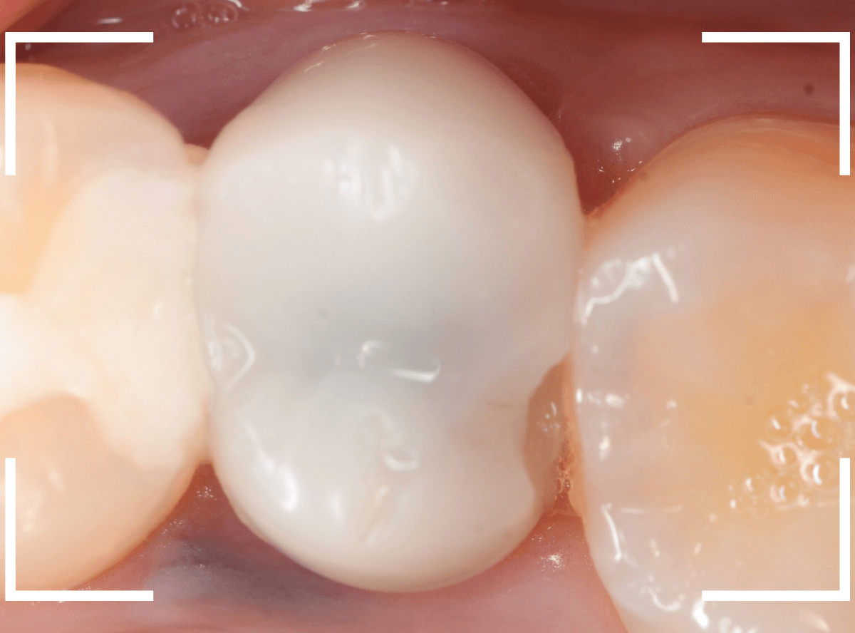 セラミック治療(クラウン・奥歯)9-11