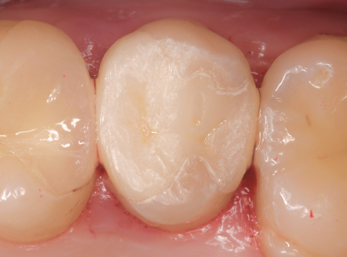 セラミック治療(インレー)15-4