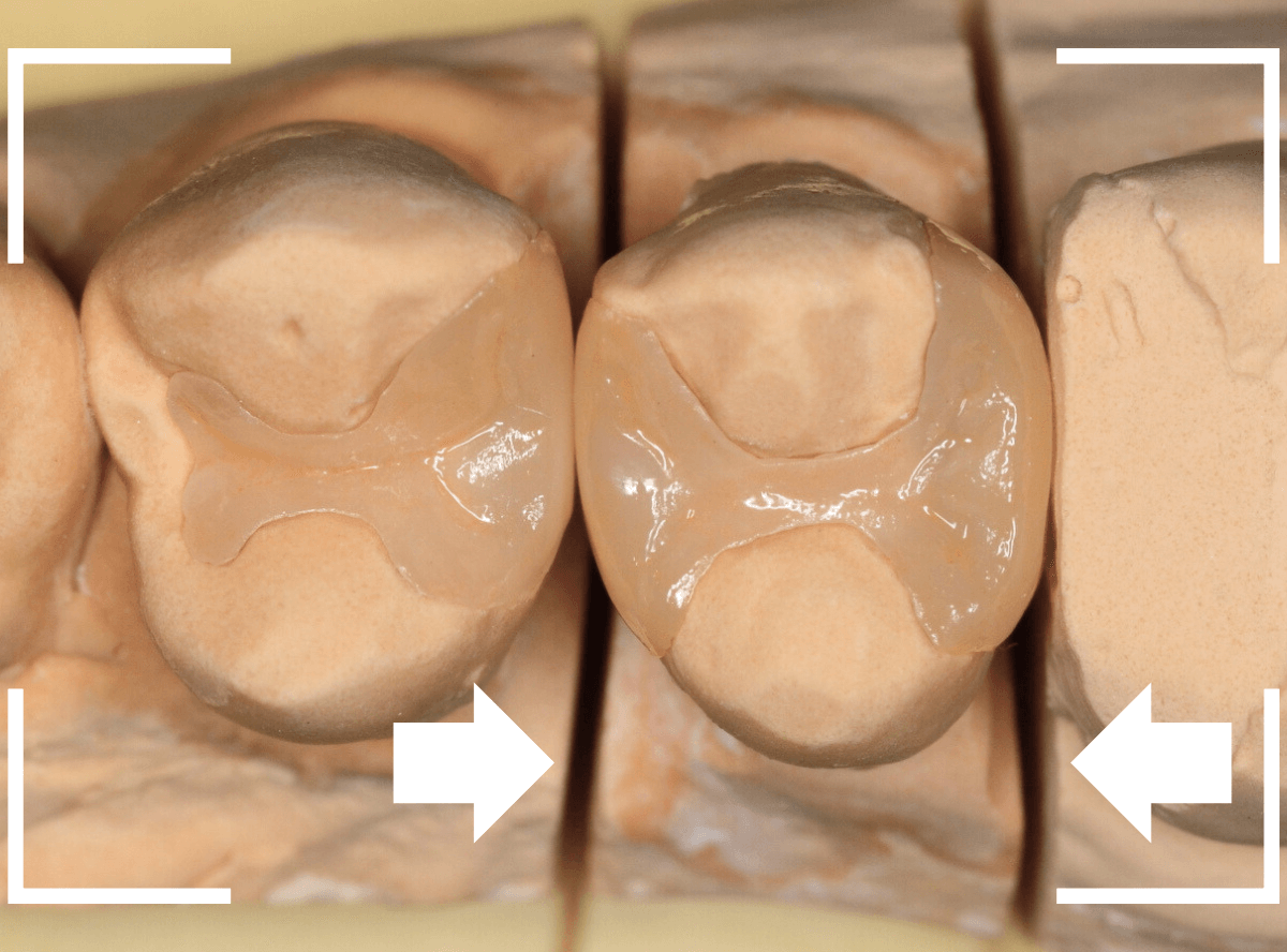 セラミック治療(インレー)21-3