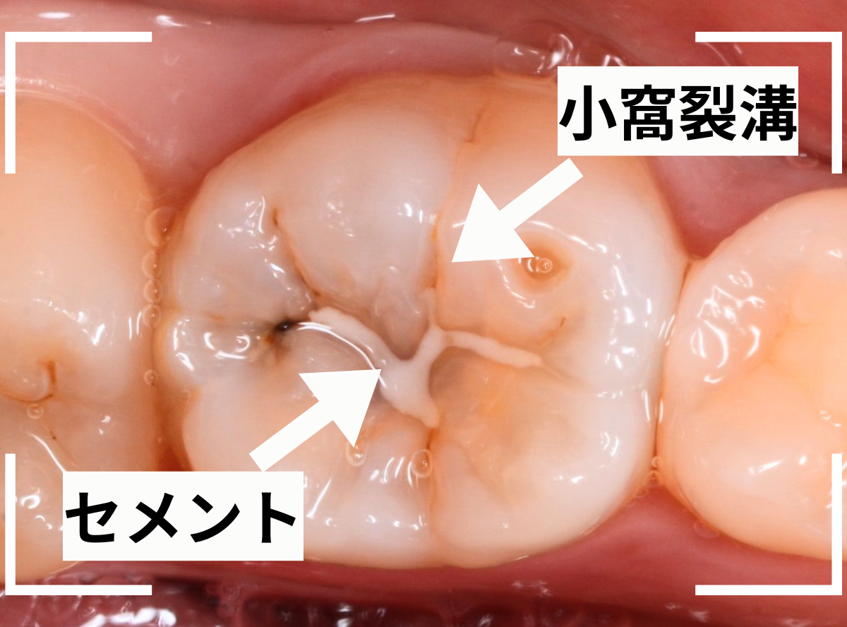 小窩裂溝う蝕1-2