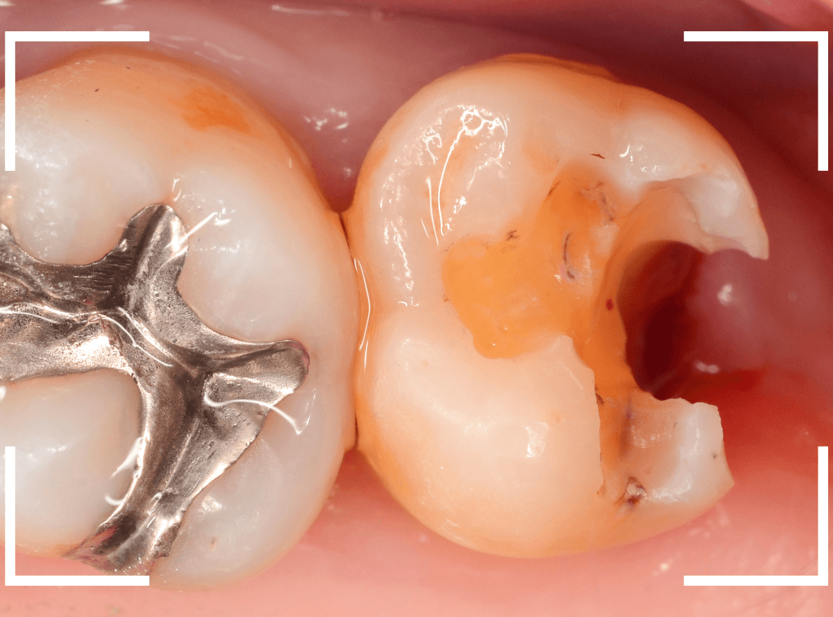 気づかないうちに深い虫歯18-6