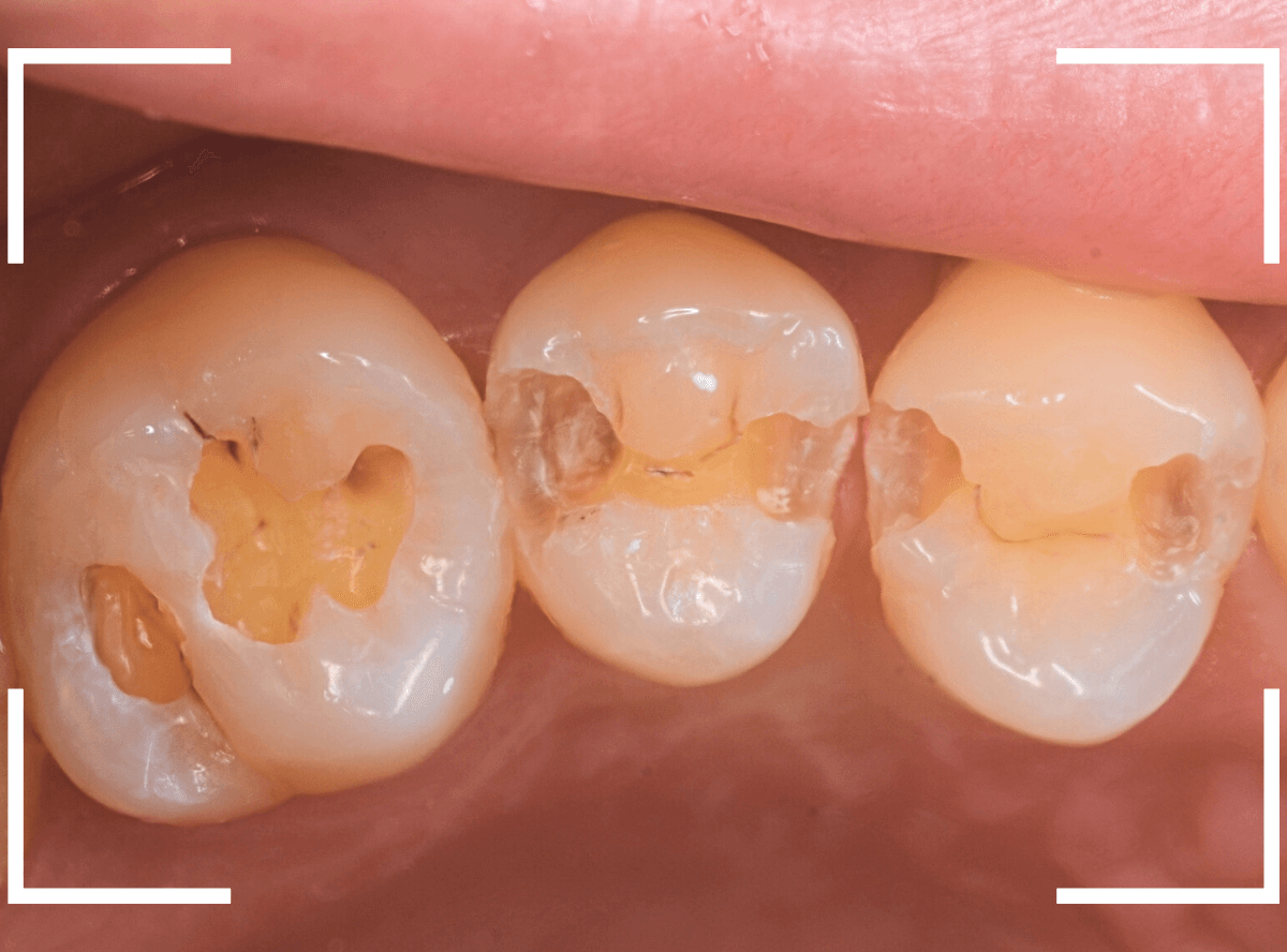 レントゲンでわかりづらい虫歯9-6