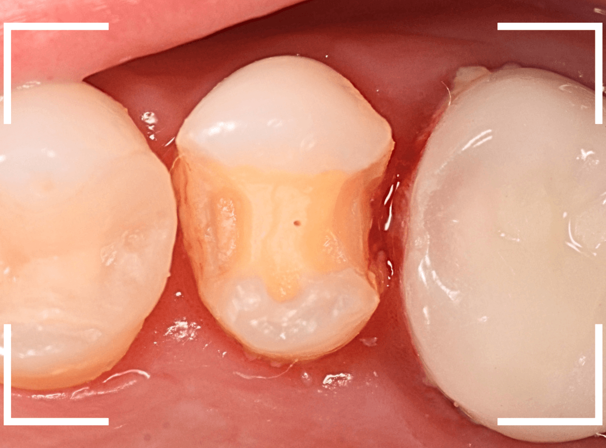 セラミック治療(インレー)22-2
