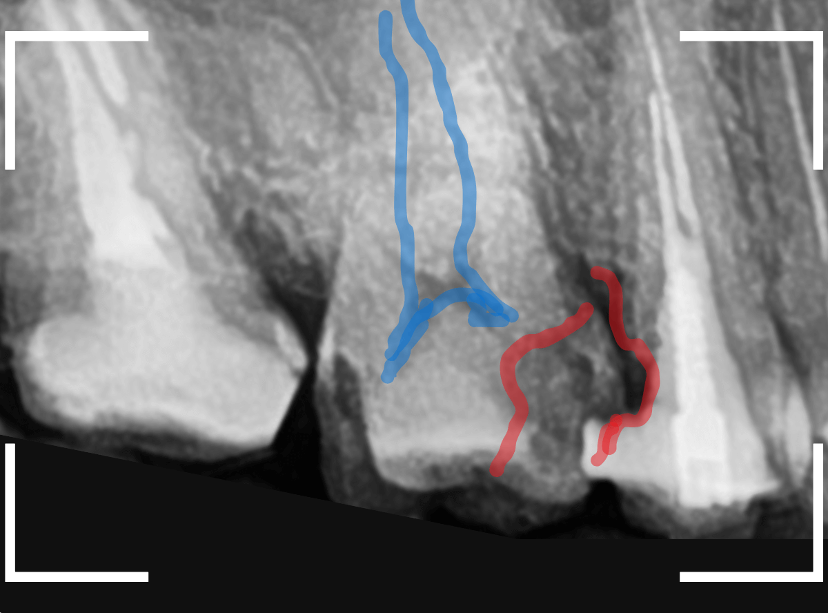 気づかないうちに深い虫歯7-2