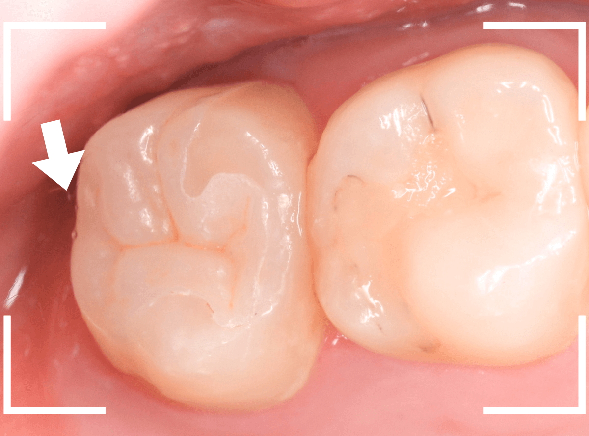 気づかないうちに深い虫歯3-9