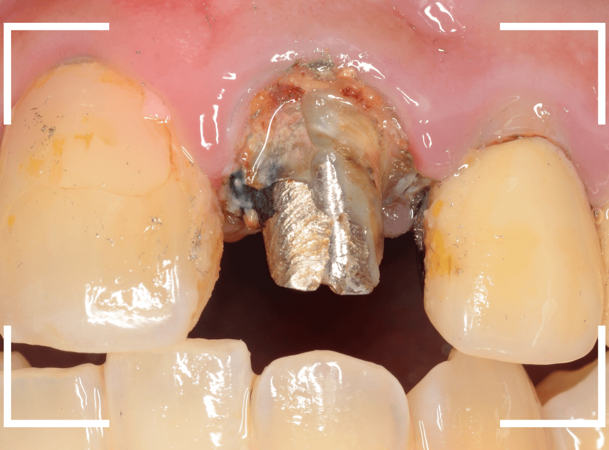 歯肉の中の歯石（歯肉縁下歯石）除去(画像）5-4