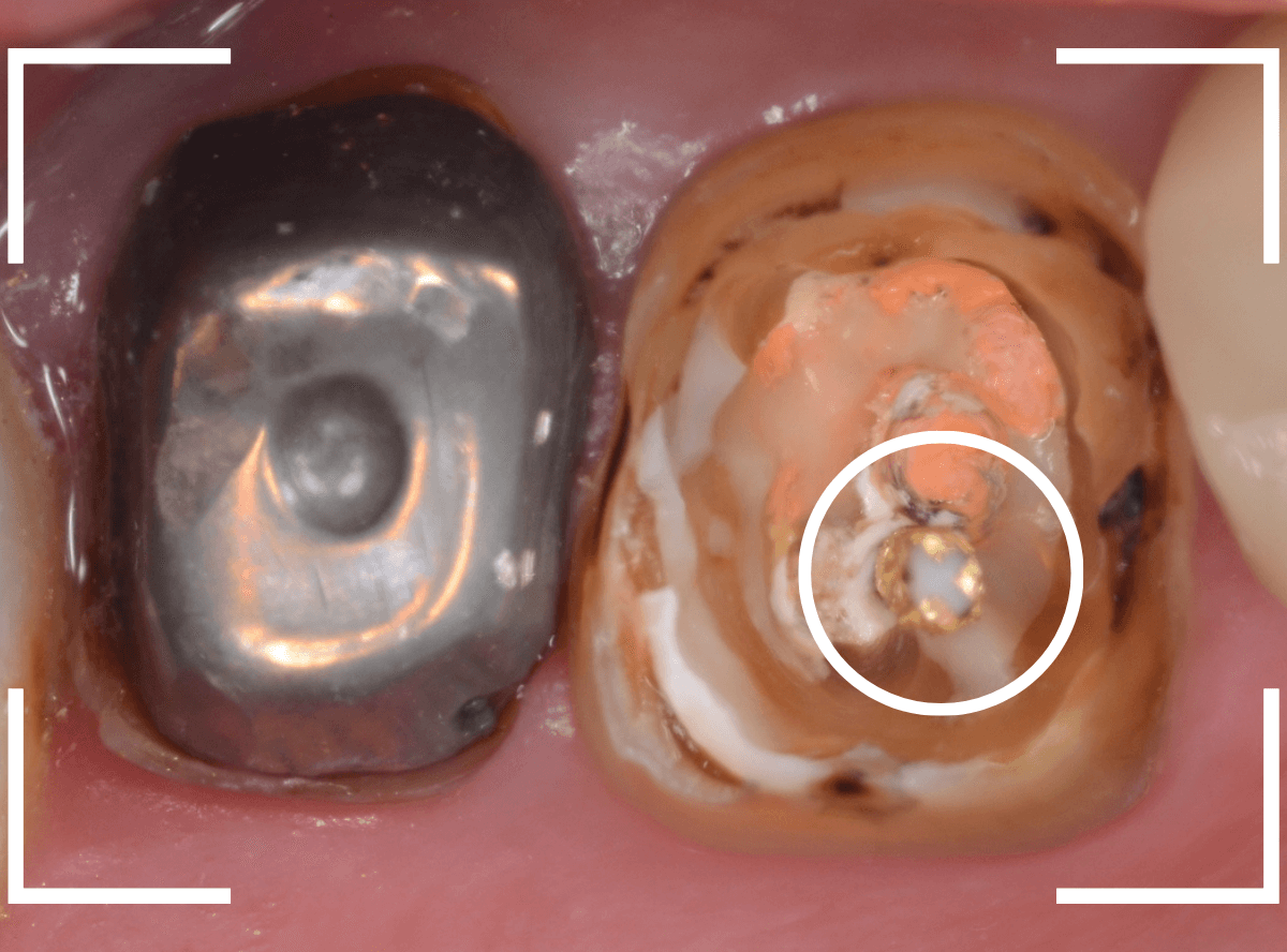 歯の土台の再治療3-3
