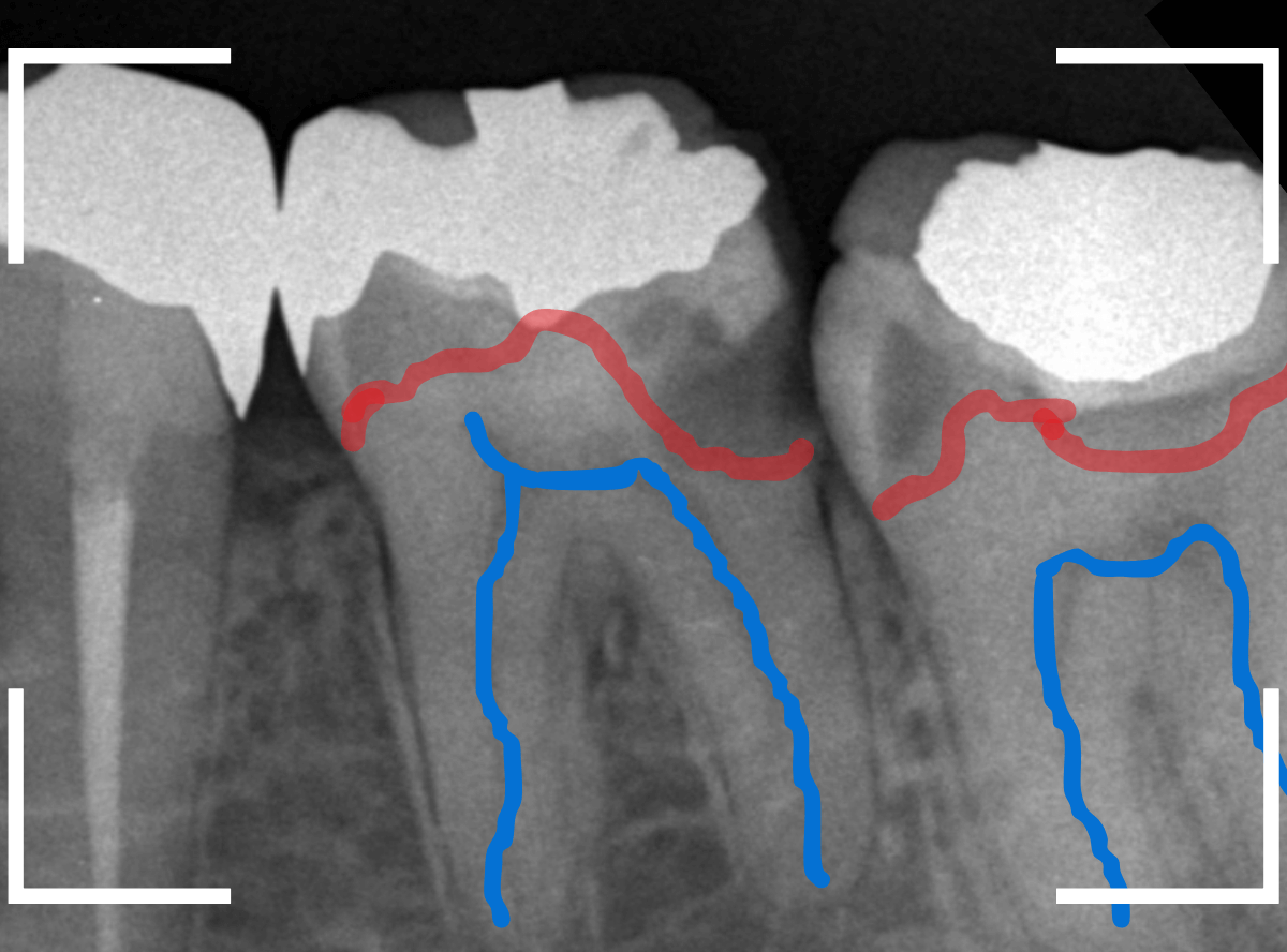つめものの下の深い虫歯(画像)10-1