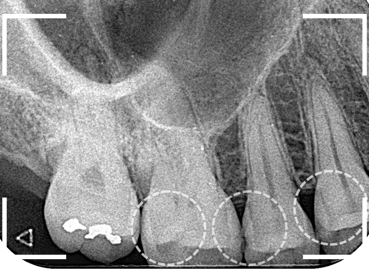 レントゲンでわかりづらい虫歯9-2
