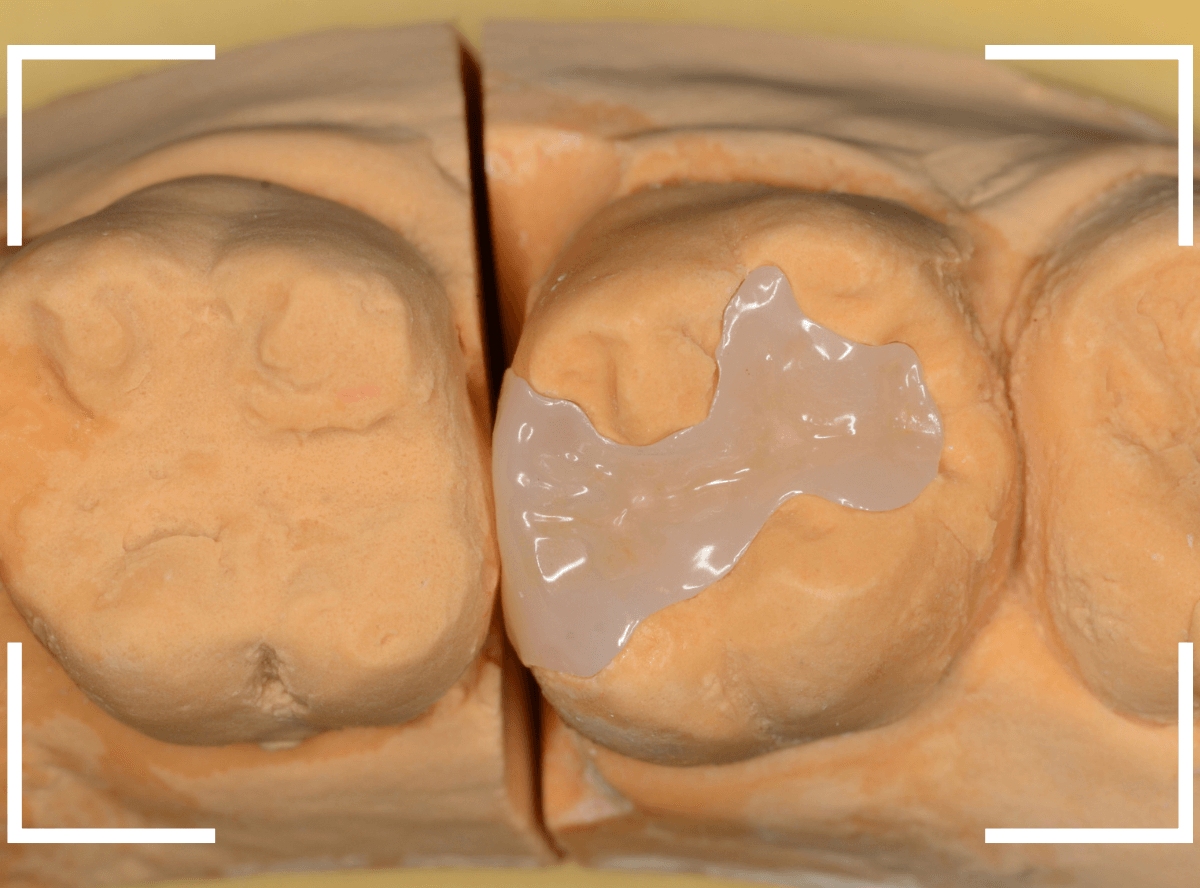 セラミック治療(インレー)29-3
