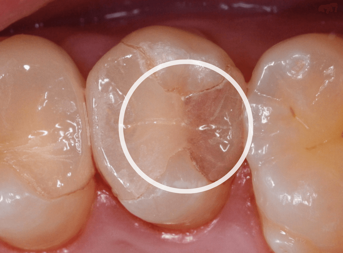 セラミック治療(インレー)15-1