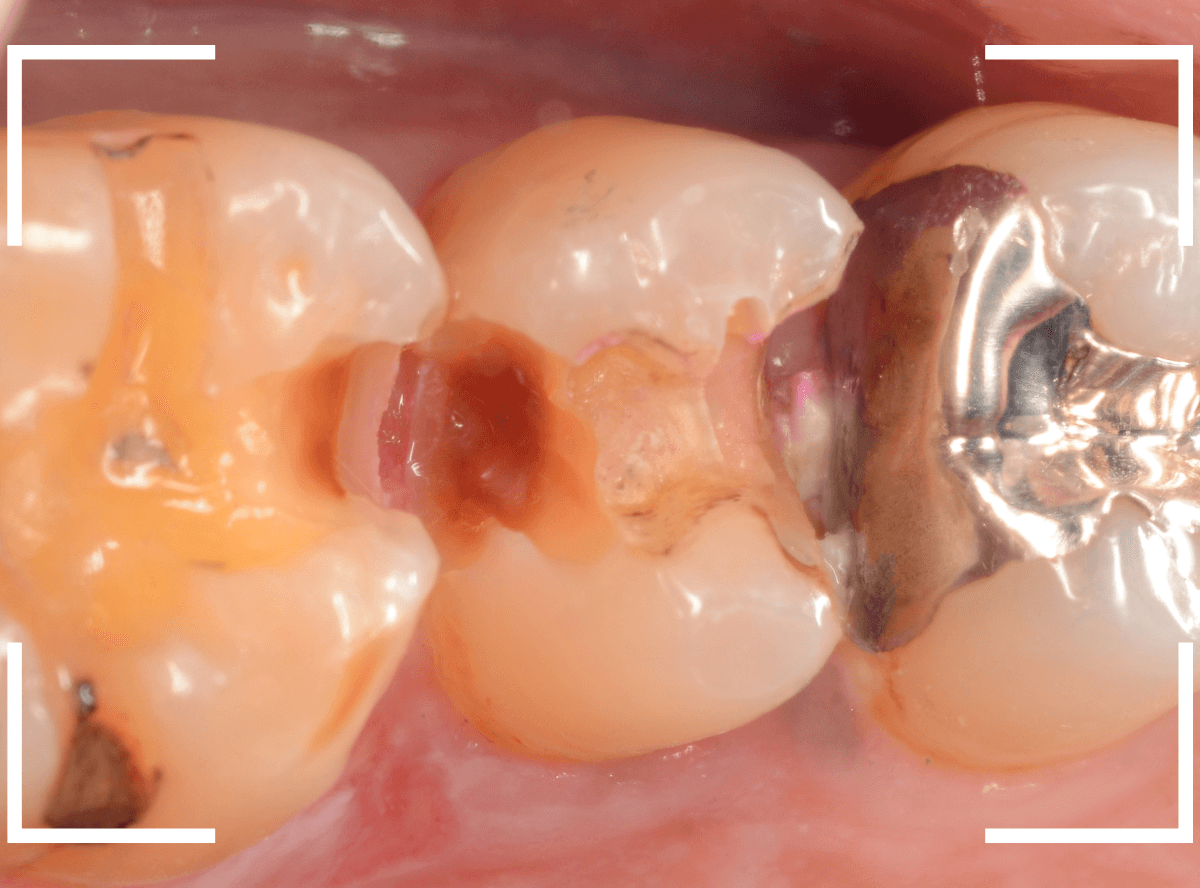 歯と歯の間の虫歯25-6