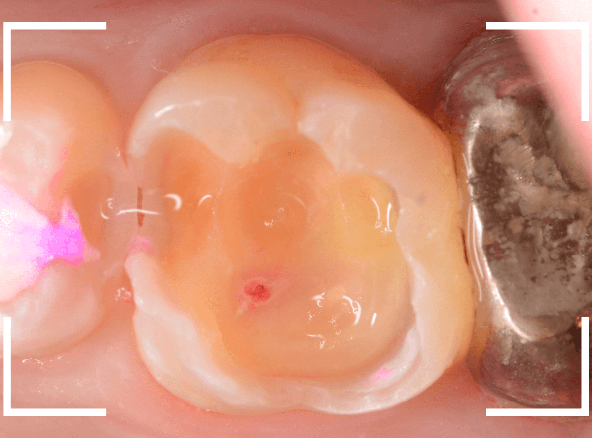 つめものの下の深い深い虫歯20-1