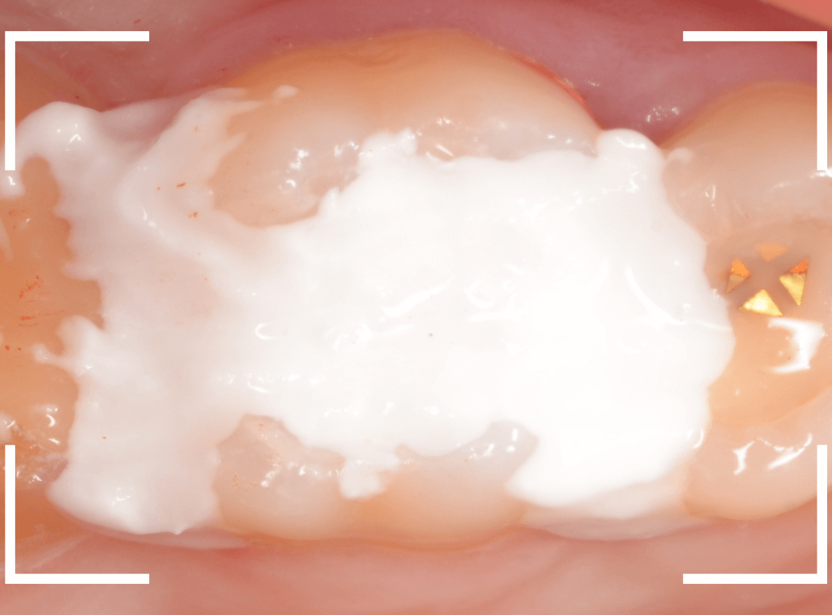 気づかないうちに深い虫歯7-6