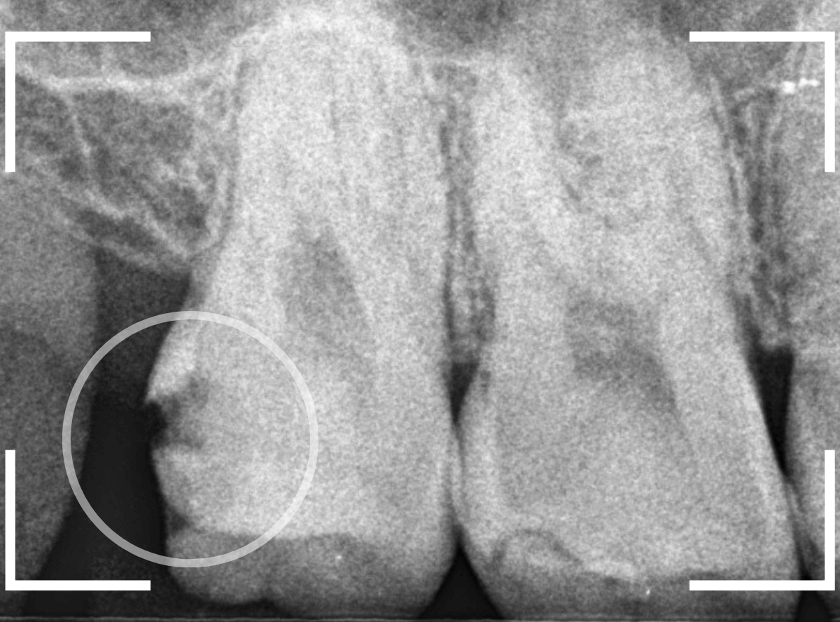 気づかないうちに深い虫歯3-3