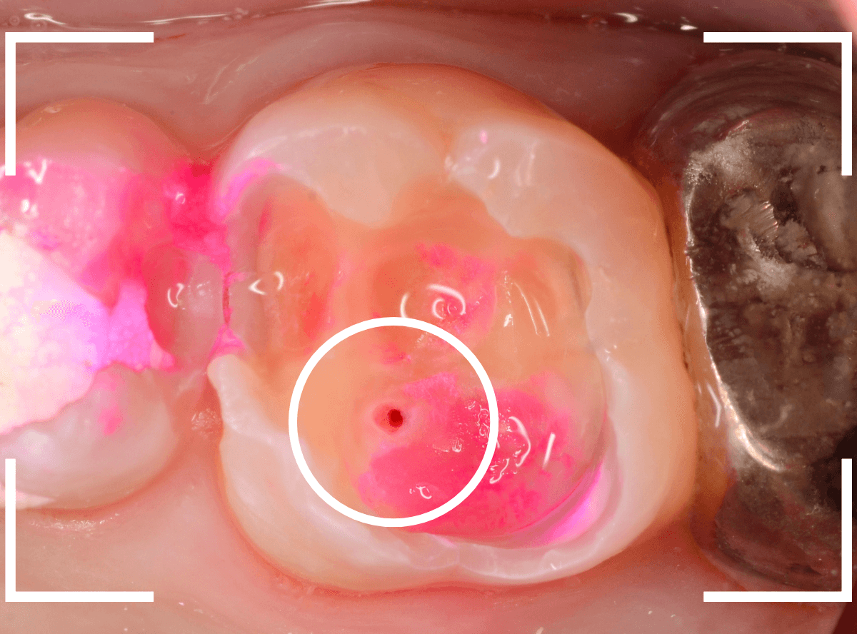 つめものの下の深い深い虫歯20-1