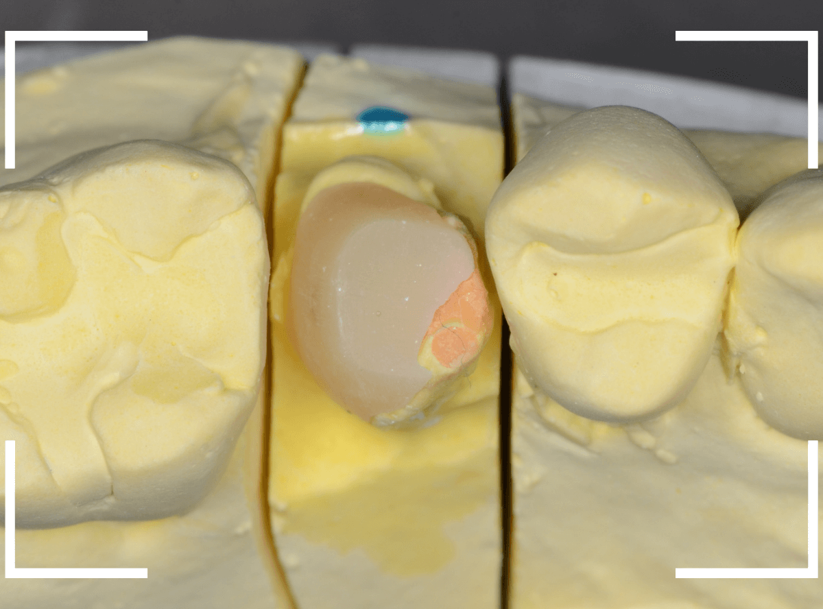 セラミック治療(クラウン・奥歯)8-5