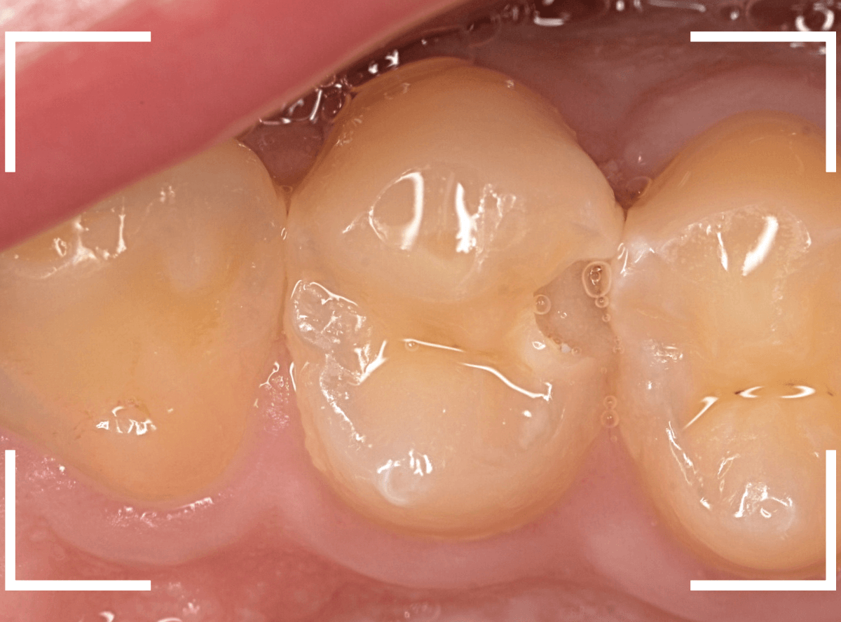 歯と歯の間の虫歯19-1
