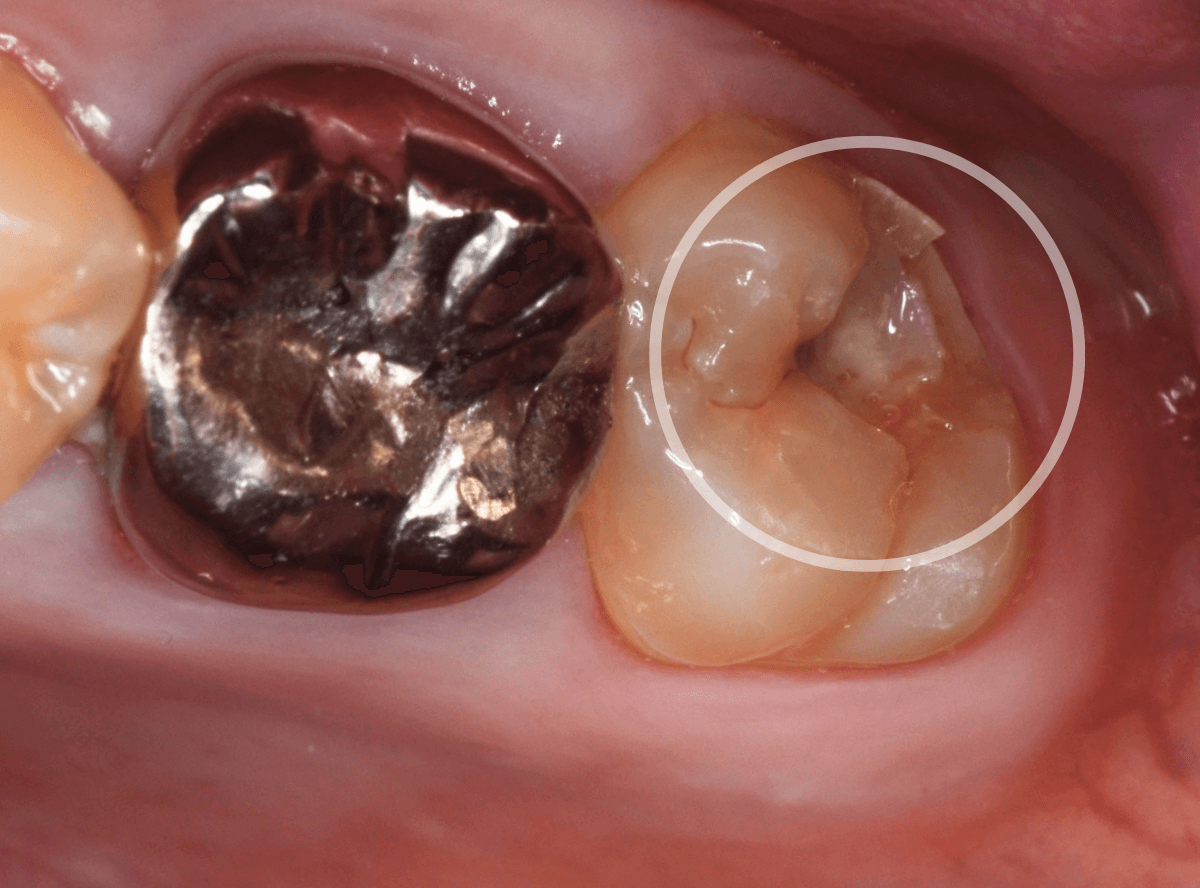 気づかないうちに深い虫歯2-1