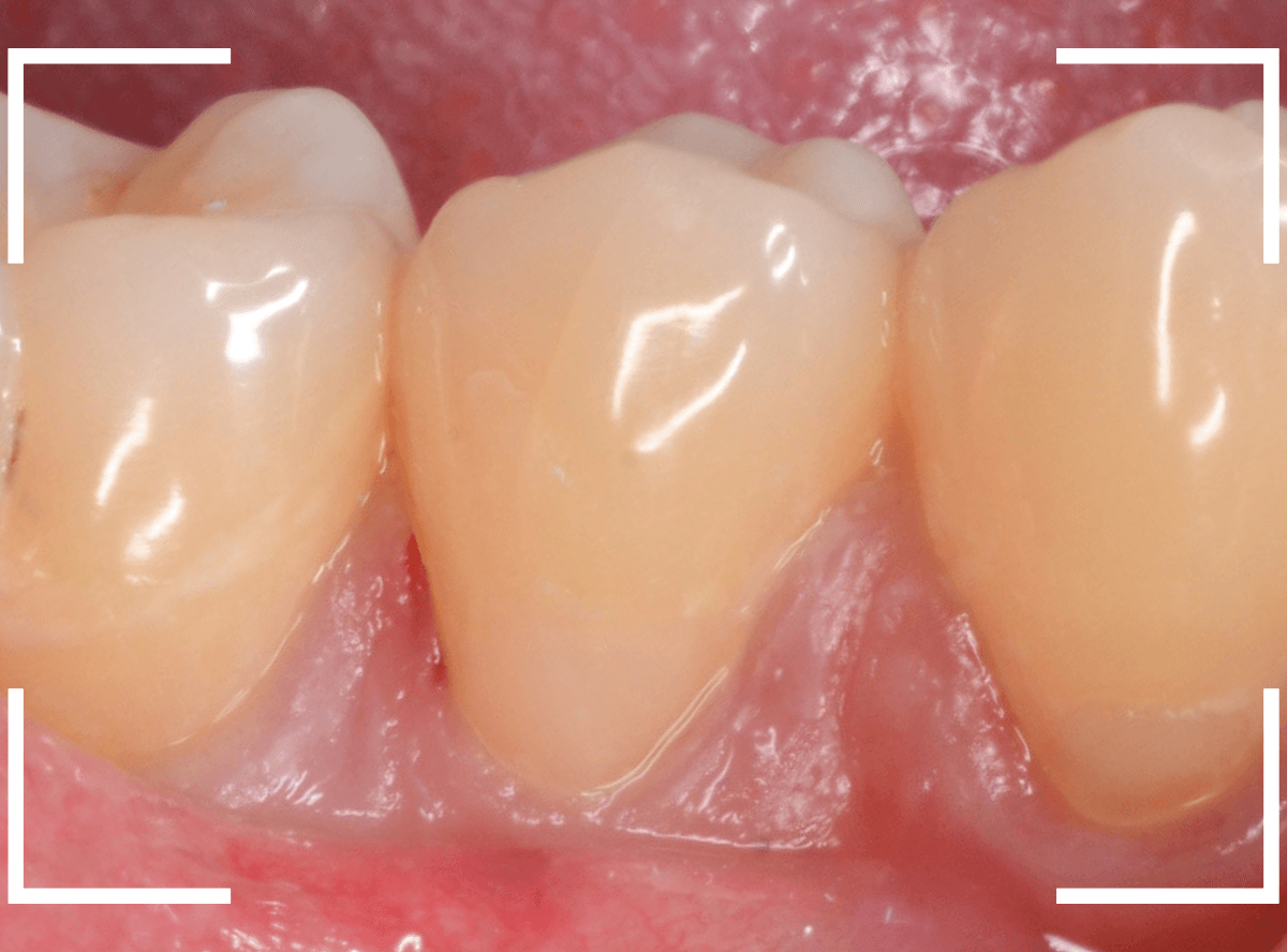 知覚過敏の画像3-3