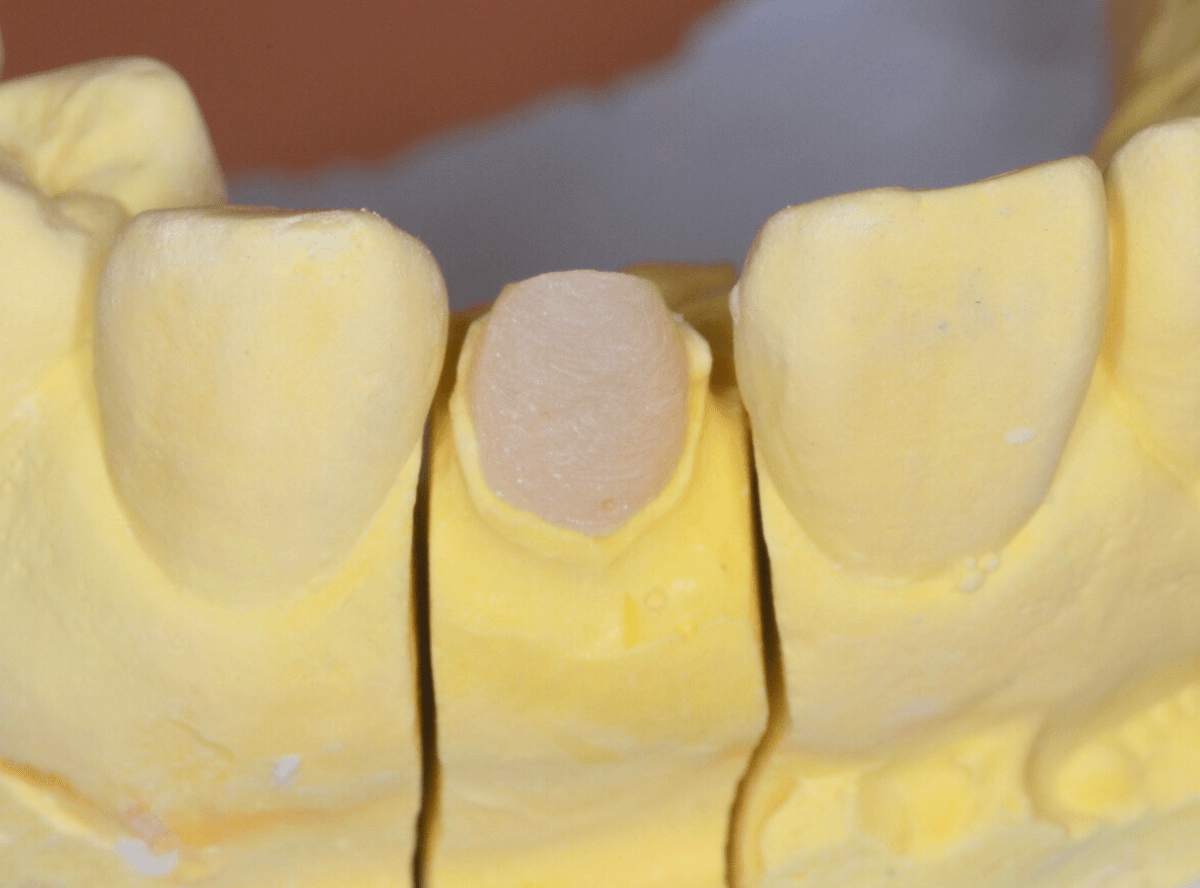 「前歯が折れた」という患者さん-3