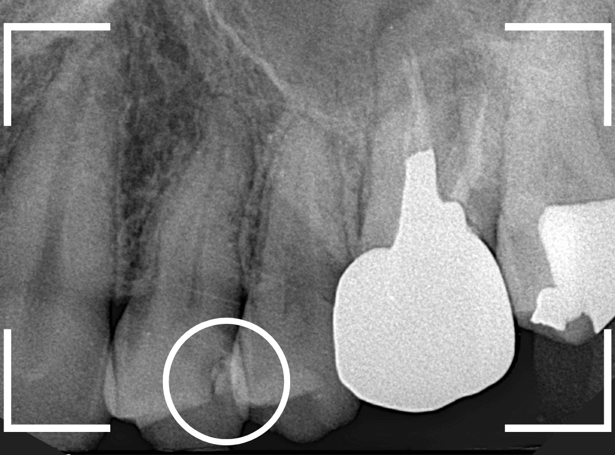 つめものの下の深い深い虫歯18-1