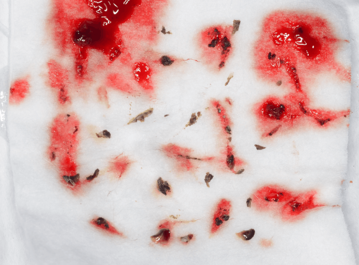 歯肉の中の歯石（歯肉縁下歯石）除去(画像）4-5