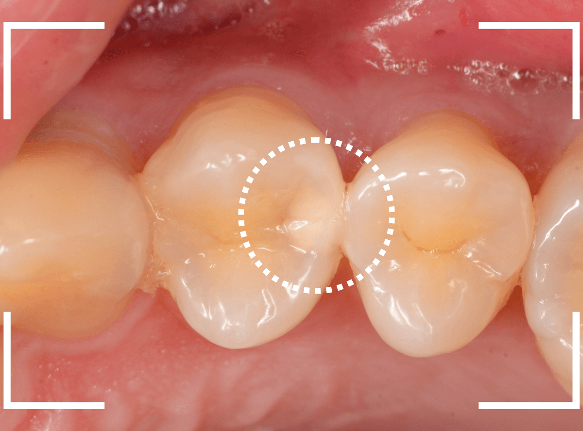 歯と歯の間の虫歯16-1