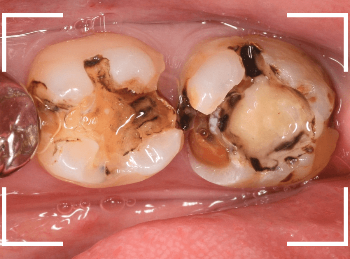 つめものの下の深い虫歯(画像)10-1