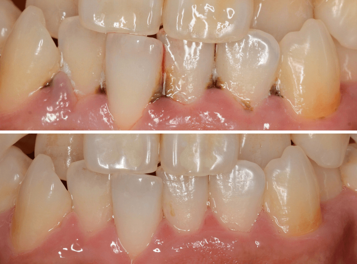 歯肉の中の歯石（歯肉縁下歯石）除去(画像）4-5