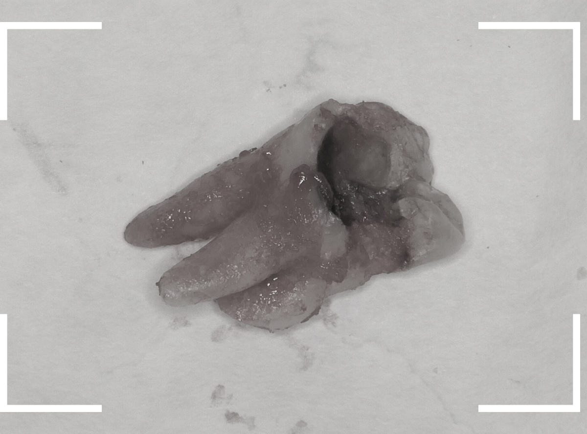 虫歯を放置して、抜歯7-4