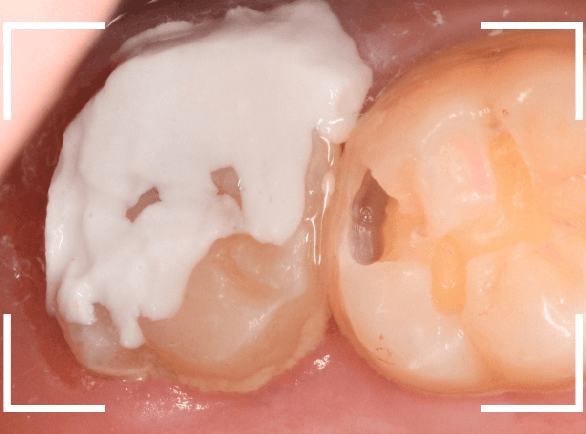 気づかないうちに深い虫歯6-5