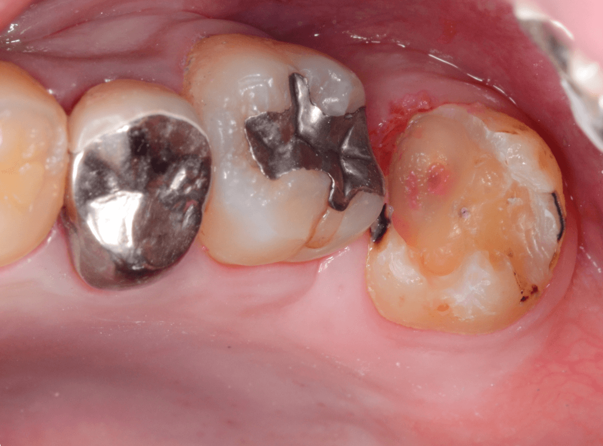 つめものの下の深い虫歯(画像)4-7