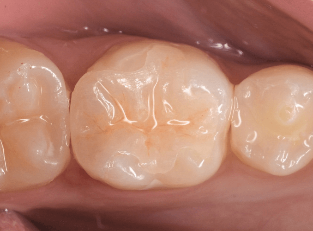 セラミック治療(インレー)7-6