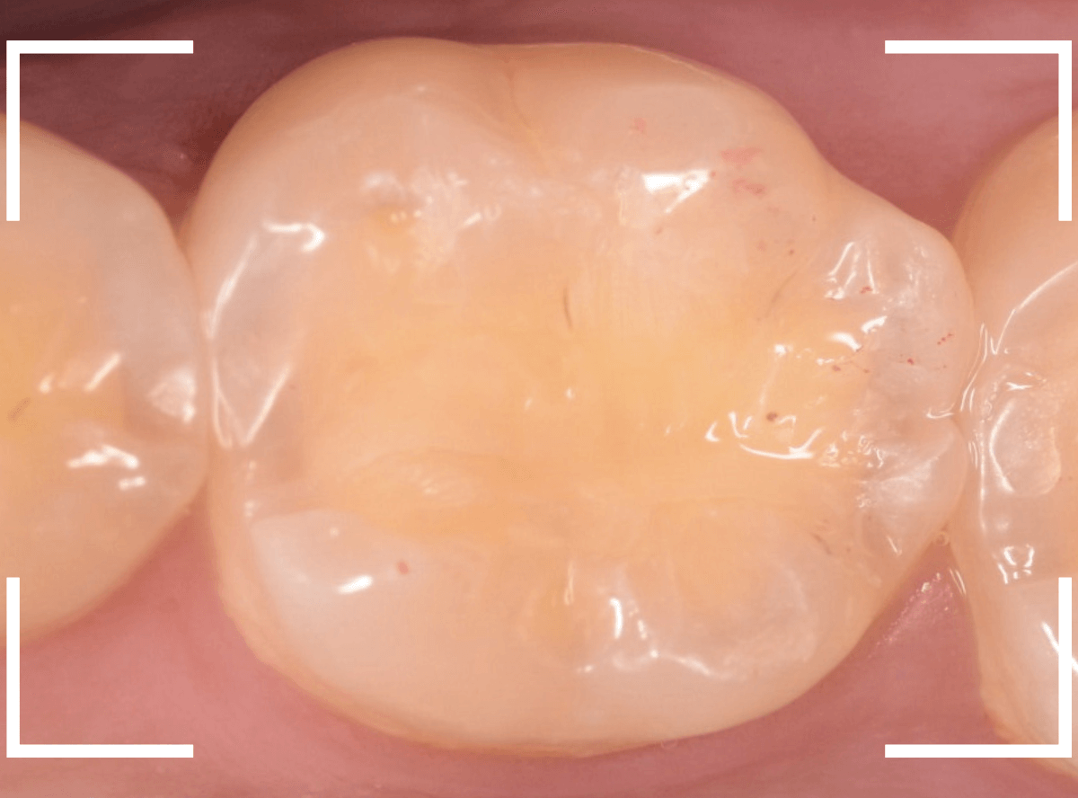 知覚過敏の画像4-4