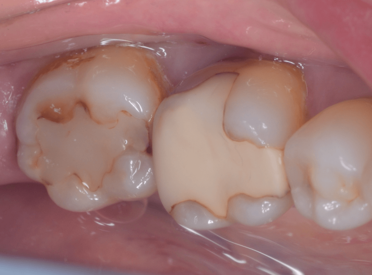 セラミック治療(インレー)8-1