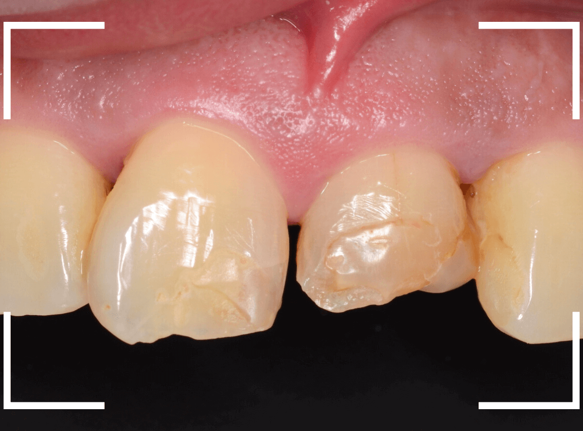 セラミック治療(前歯・クラウン)5-12