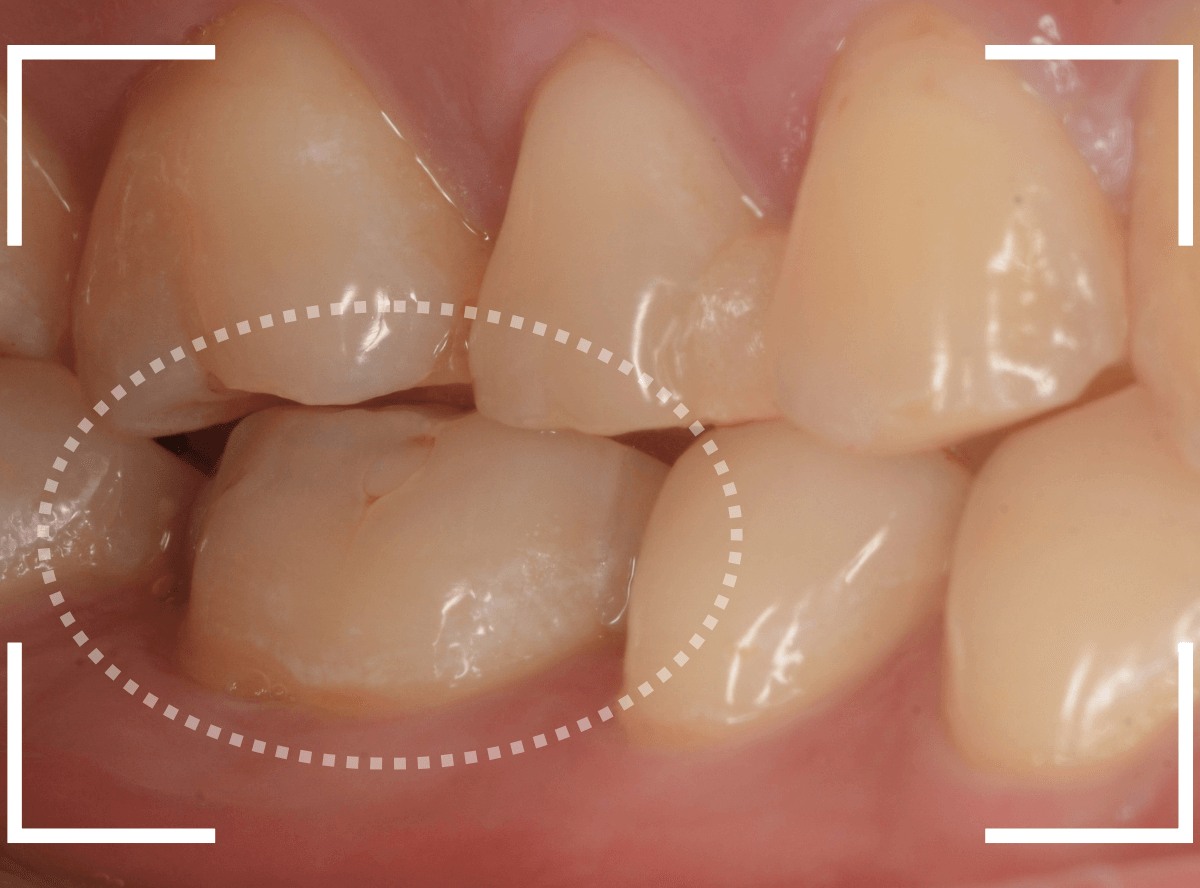 セラミック治療(インレー)29-5