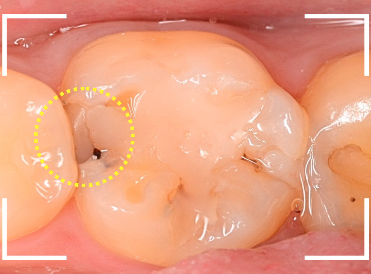 レントゲンでわかりづらい虫歯6-1